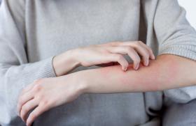 La dermatite atopique à l’ère de l’arrivée des anti-JAK