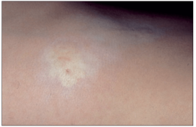 Pathologie Vulvaire Pediatrique Dermatologie Pratique