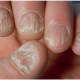 L’ongle, une mystérieuse boule de cristal ? –  De l’onychomancie à la dermatologie, peut-on vraiment lire sur les ongles ?